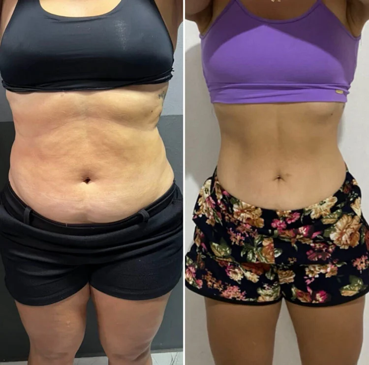 Antes e Depois